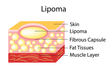 Lipoma are adipose tumors located in the subcutaneous tissues.