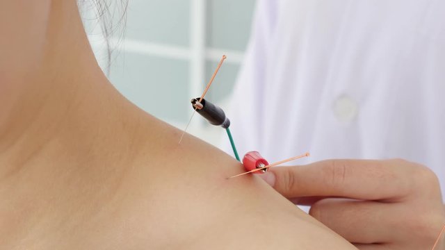 Asian woman receiving acupuncture with electric stimulation at shoulder in a hospital,Chinese alternative medicine concept.