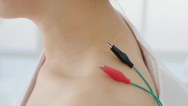 Asian woman receiving acupuncture with electric stimulation at shoulder in a hospital,Chinese alternative medicine concept.