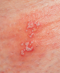 Fototapeta premium skin irritation in the form of blisters and inflammation