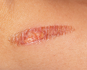 burn mark on the skin of the hand