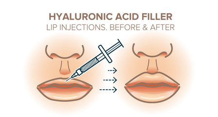 Lip injections. Hyaluronic acid filler. Before and after. Vector illustration