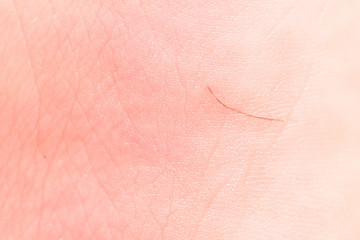 Fototapeta premium Dark hair under the skin of a children leg, close-up, macro shot