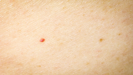 The texture of human skin with a mole, freckles and age spots.