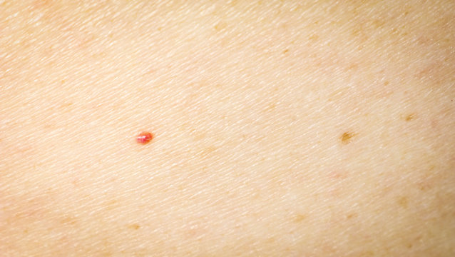 The texture of human skin with a mole, freckles and age spots.
