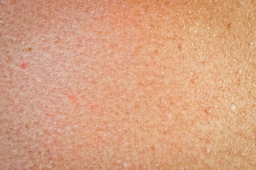 The texture of human skin with freckles and age spots.