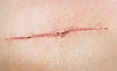 A seam after surgery on the skin of a person’s back. Surgical transplantation of a muscle flap from the back. Stitched wound self-absorbable threads, closeup. Scabs on a healing wound.