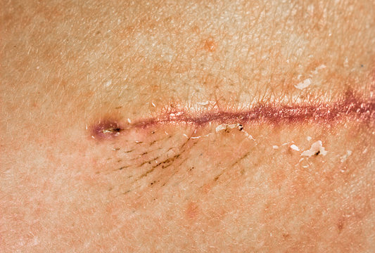 A seam after surgery on the skin of a person’s back. Surgical transplantation of a muscle flap from the back. Stitched wound self-absorbable threads, closeup. Scabs on a healing wound.