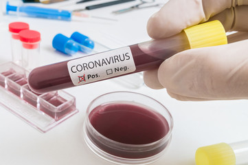 Hand holds test tube for Coronavirus 2019-nCOV analysis.