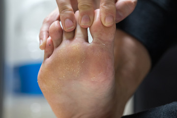 Pitted keratolysis is a bacterial skin infection on the feet