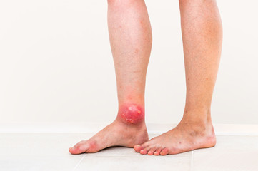 Red rash on leg of patient who was bitten by an insect