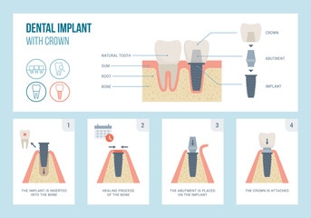 Dental implant medical procedure and structure - obrazy, fototapety, plakaty