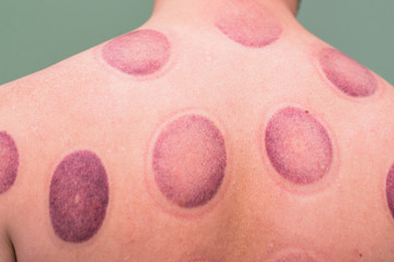 Hematoma after a session of vacuum cans. Back treatment in a hospital or massage parlor. A man...