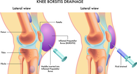 Labelled medical illustration showing knee bursitis drainage procedure.