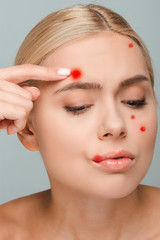 displeased and naked girl touching face with red pimples isolated on grey