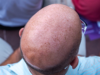 close up baldness from top of head - obrazy, fototapety, plakaty