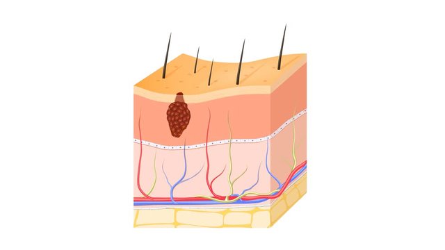 Skin cancer: Squamous cell carcinoma, basal-cell cancer (begins in the basal cells) and Melanoma (arises in the pigment cells, melanocytes). layers of human skin and healthy epidermis