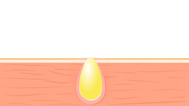 Formation of skin acne or pimple. The sebum in the clogged pore promotes the growth of a certain bacteria. This leads to the redness and inflammation associated with pimples