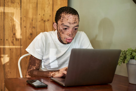 Young man with vitiligo working on his computer in a cafeteria