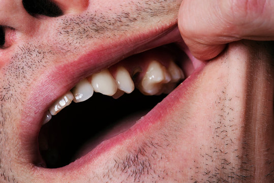 Man,showing mouth without tooth (broken) using fingers