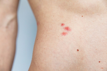 Herpes on body. Skin disease. Professional doctor examining skin of a patient.