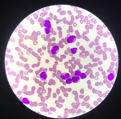 Immature cell or bast cell in leukemia patiens.