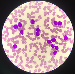 Immature cell or bast cell in leukemia patiens.