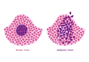 cancer and tumor cell stage and development vector	/  malignant and benign type