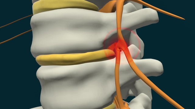 Spinal disc herniation, 3d educational animation