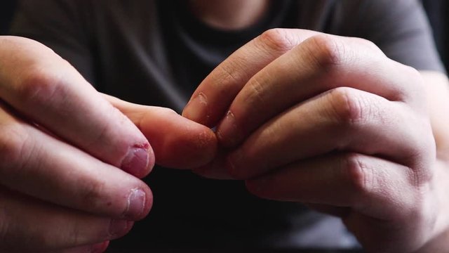 Close view of male hands with strongly bitten nails. Finger selection with alarm. Ugly bitten fingers, cuticles, wounds on the fingers. Bad habit. The concept of onychophagy and dermatophagy.