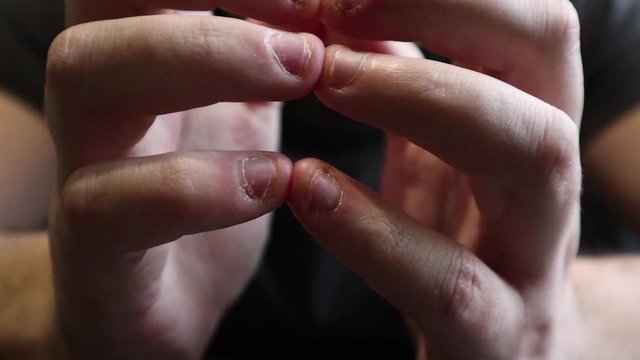Close view of male hands with strongly bitten nails. Finger selection with alarm. Ugly bitten fingers, cuticles, wounds on the fingers. Bad habit. The concept of onychophagy and dermatophagy.