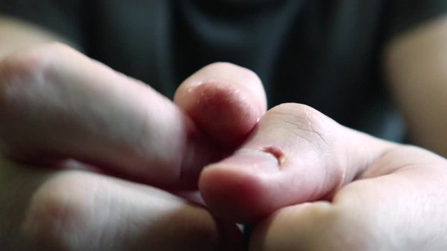 Close view of male hands with strongly bitten nails. Finger selection with alarm. Ugly bitten fingers, cuticles, wounds on the fingers. Bad habit. The concept of onychophagy and dermatophagy.