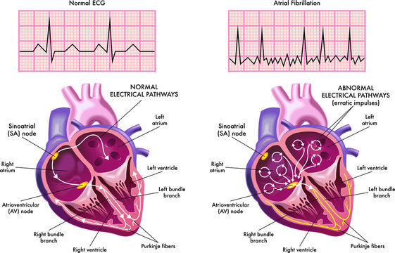 Medical illustration showing the symptoms of a heart with atrial fibrillation compared to normal one.