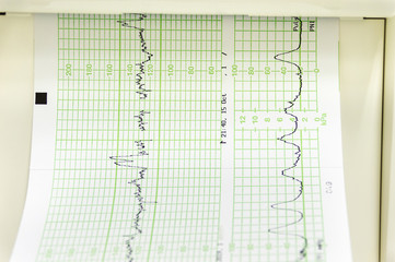 Electrocardiogram in paper form at hospital