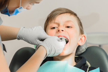 The boy with his mouth open lies in the dentist's chair while the orthodontist holds the plate on his teeth.
