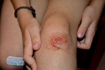 Fresh bleeding wound, child holds knees with hands