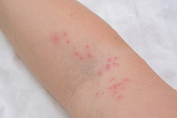Fototapeta premium Skin rash on female arm, itchy pimples as a result of an allergic reaction, response, concept of allergy and dermatology