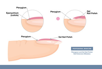 Pterygium and Gel Nail Polish. Nail Extension Mistakes. Professional Manicure Tutorial. Vector illustration