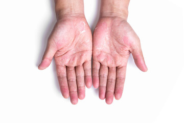 Dry hands, peel, Dermatitis.Allergic to chemicals.Eczema