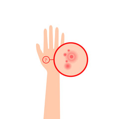 increased scheme eczema on human hand