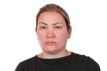 Fototapeta premium portrait of a woman with hormonal disorders