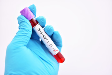 Fototapeta premium Blood sample tube positive with coronavirus 2019 or 2019-nCoV, novel coronavirus found in Wuhan, China