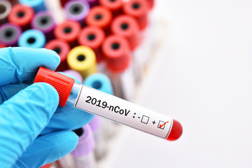 Obraz premium Blood sample tube positive with coronavirus 2019 or 2019-nCoV, novel coronavirus found in Wuhan, China