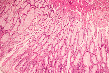 View in microscopic of ductal cell carcinoma, adenonocarcinoma from human breast cancer, tissue...
