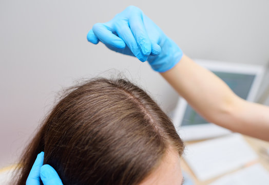 a dermatologist trichologist examines the hair of a young woman patient. Trichology is the science of the condition and structure of hair. Hair health.