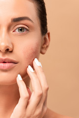 cropped view of girl touching face with problem skin and looking at camera isolated on beige