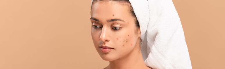 panoramic shot of girl with acne on face isolated on beige