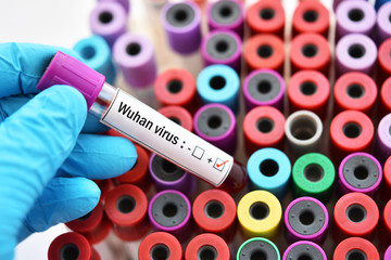 Fototapeta premium Blood sample tube positive with Wuhan virus, novel coronavirus 2019 found in Wuhan, China