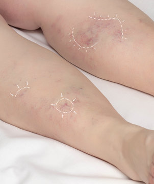 Markers on the legs of a woman before surgery to treat and remove leg veins. The concept of treatment of varicose veins and thrombophlebitis, phlebology and phlebectomy