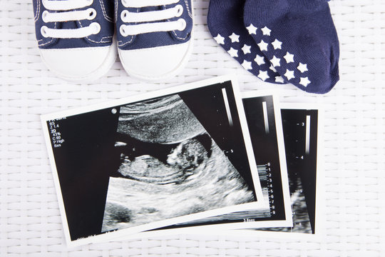 Pregnancy ultrasound, first trimester 